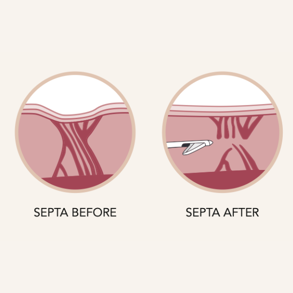 Septa before and after cellulite treatment